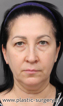 Open facelift, endoscopic lifting, upper and lower blepharoplasty